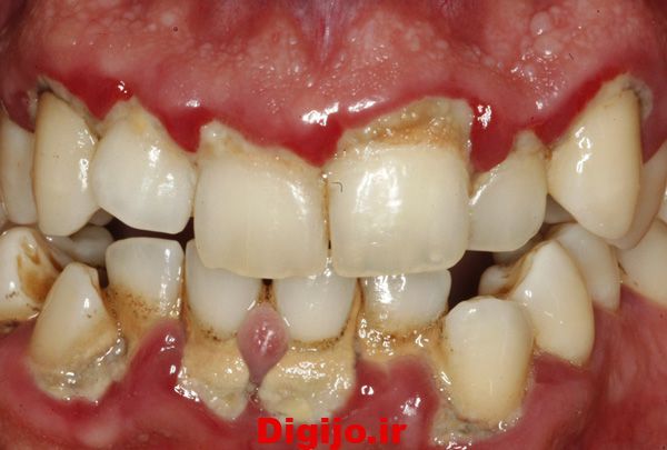 بیماری پریودنتال از دلایل دندان درد